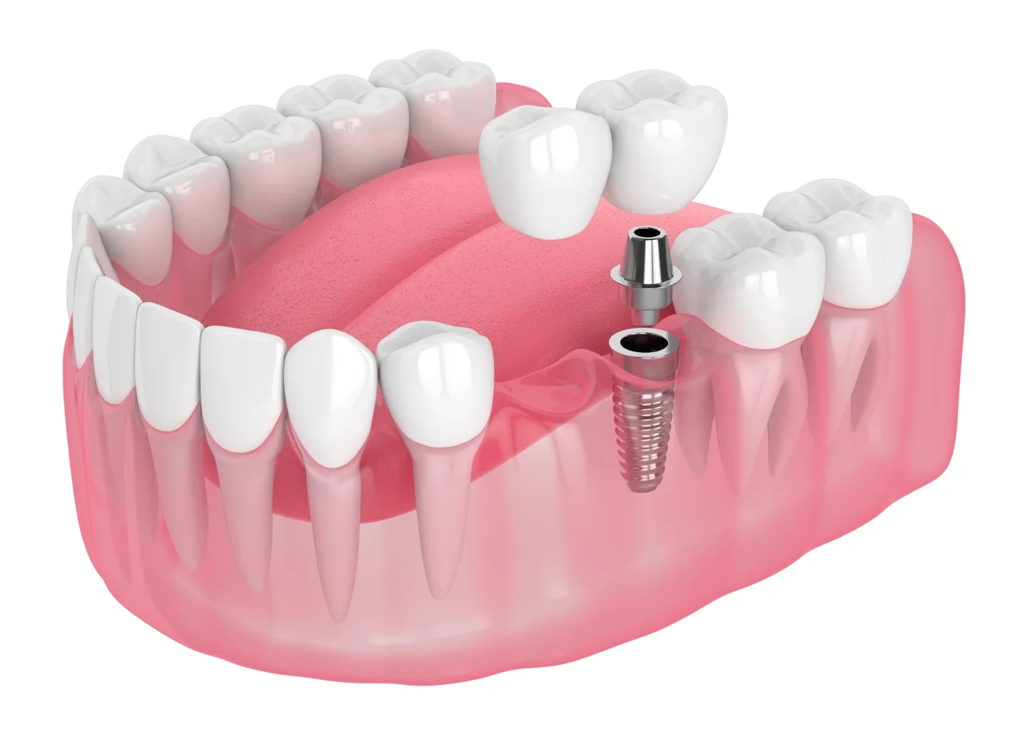 Implantes dentales