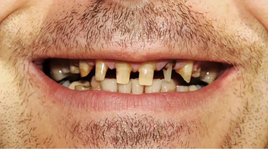 sonrisa antes 2 e1776681641995