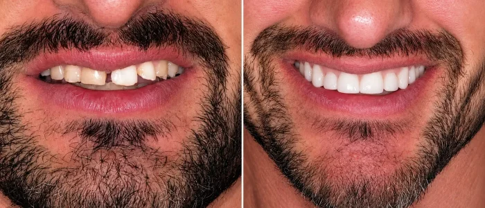 Antes-despues-carillas-dentales-caso-2